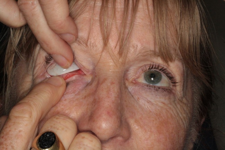 Prosthetic eye care New Zealand Prosthetic Eye Service