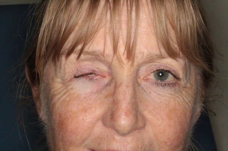 Prosthetic eye care New Zealand Prosthetic Eye Service