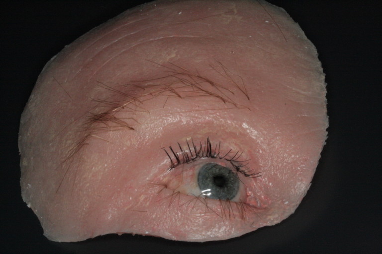 Orbital Prostheses - Ocularist in New Zealand